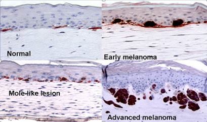Modeling melanoma in sythentic skin.