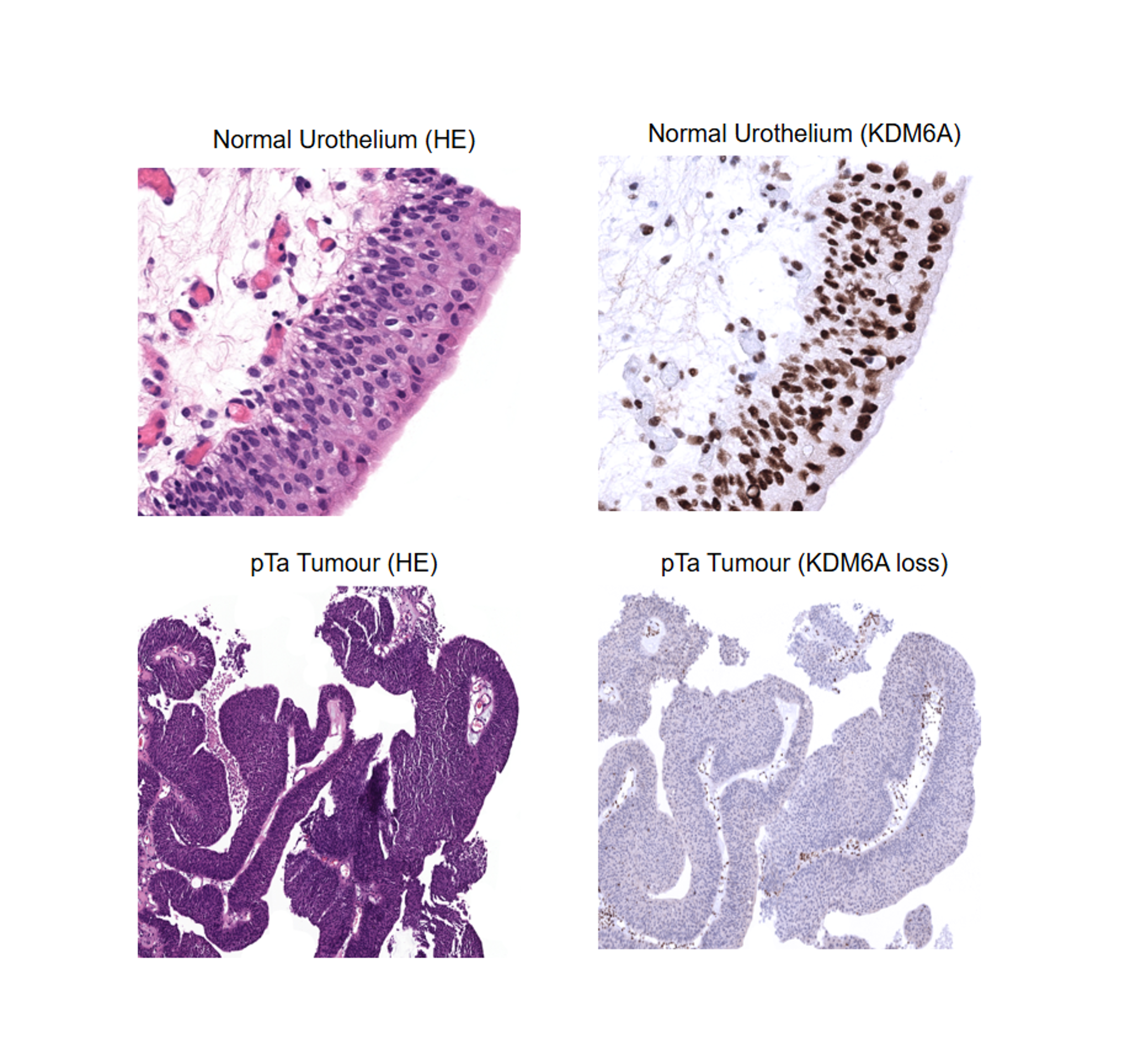 KDM6A - A new tool for detection of urothelial neoplasia